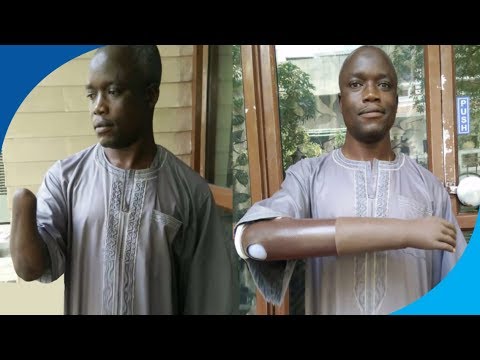 Prosthetic Arm Implantation in India | Patient from Nigeria