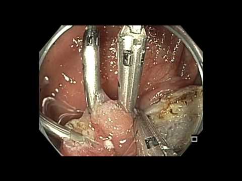 Colonoscopia - RME de válvula IC - cierre de clip 