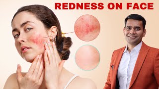 Reduce Redness On Face |  Herbs , Diet Plan And Remedies - Dr. Vivek Joshi