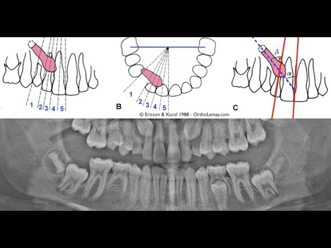Impacted Canines: A Brother-and-Sister Case Study