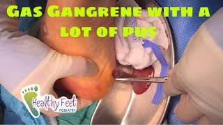 Gas Gangrene: Pus Pouring out of a Foot Tampa