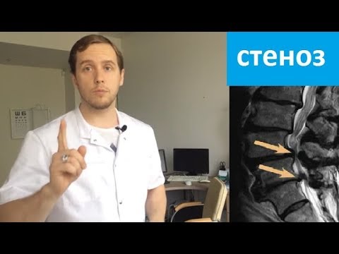 Структура позвонков шейного отдела Шишка на шее слева не болит