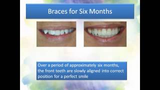 preview picture of video 'Braces For Six Months'