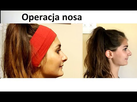 Operacja nosa , moje wrażenia, dużo zdjęc przed i po