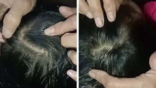 Download lagu 😱😱😱Habis keramadicariin kutunya biasanya kalo habis keramas suka bnyak kutunya  mp3 Download lagu 😱😱😱Habis keramadicariin kutunya biasanya kalo habis keramas suka bnyak kutunya  mp3