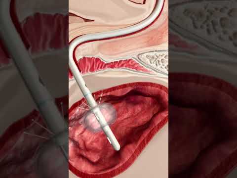 urinary catheter