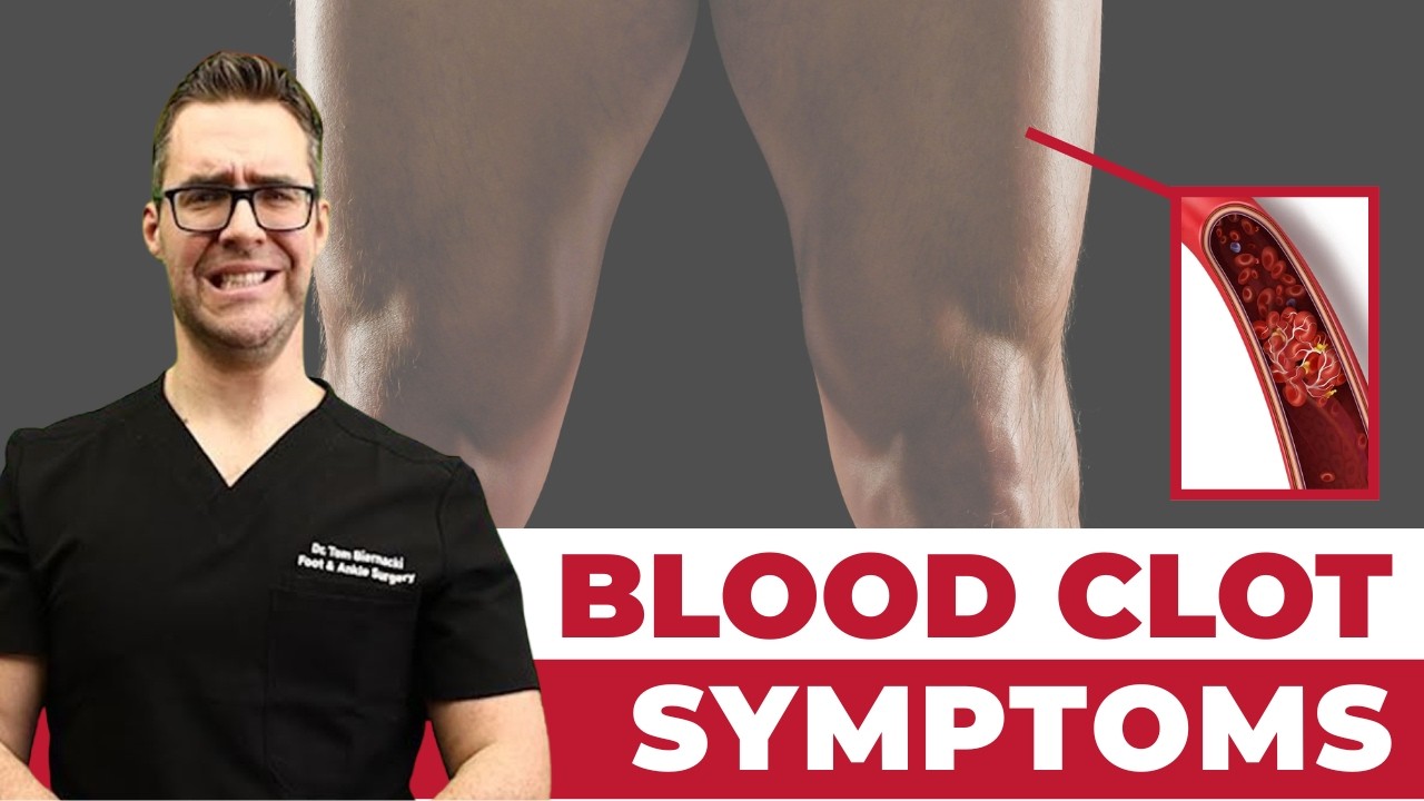 Blood Clot Symptoms & Signs [Causes & Treatment of Leg Blood Clots]