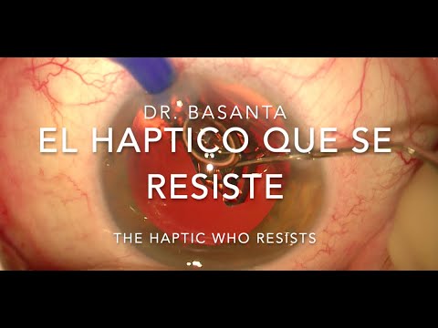 Phaco Tip: El haptico que se resiste