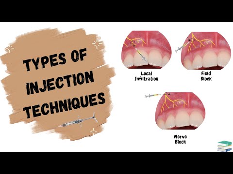 Types of Injections used in Dentistry | Local Anesthesia