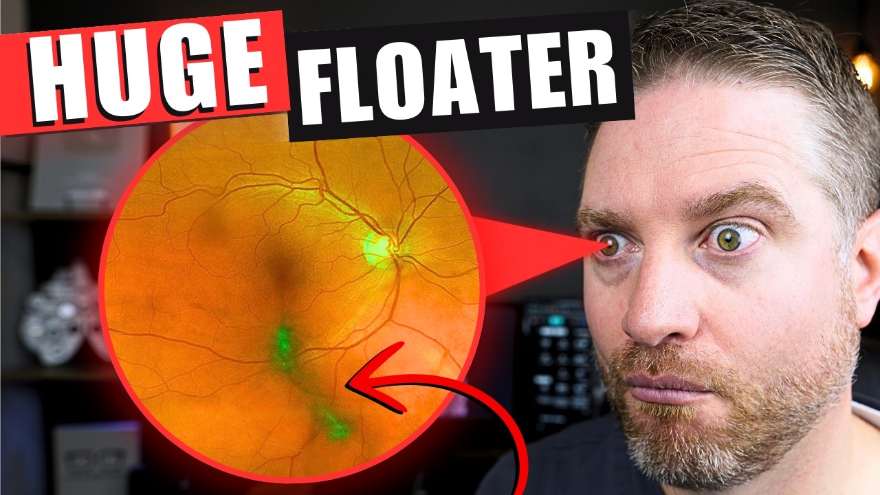 What Causes This Huge Eye Floater!? PVD Treatments Explained