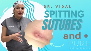 Spitting Sutures