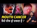 Mouth CANCER TREATMENT In Hindi मुँह का कैंसर Cancer Treatment Dr Avinash Chai