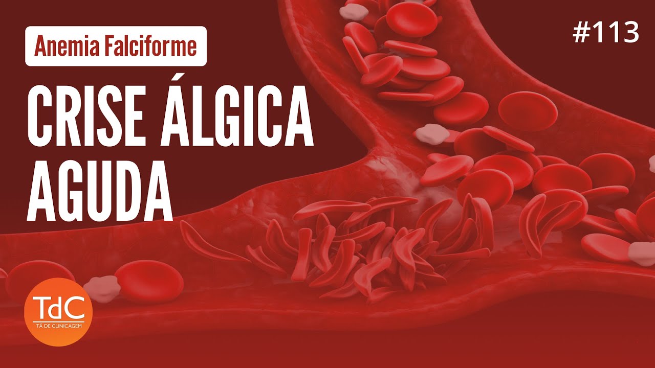 Anemia Falciforme - Crise Álgica Aguda: Episódio 113