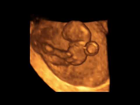 Embarazo de 8 a 9 semanas en ultrasonido 3D