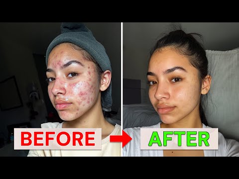 The Fastest Way to Get Rid of Acne