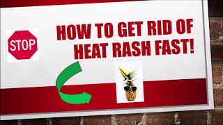 How to get rid of heat rash fast!