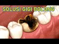 Bukan DICABUT Bukan DITAMBAL ️ Ini Solusi GIGI BERLUBANG ️