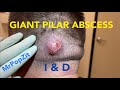 Giant Scalp Abscess with F/U’s. Swelling and VERY painful.Incision & Drainage done.Wait till the end