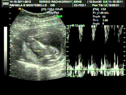 nosso primeiro bebe 13semanas