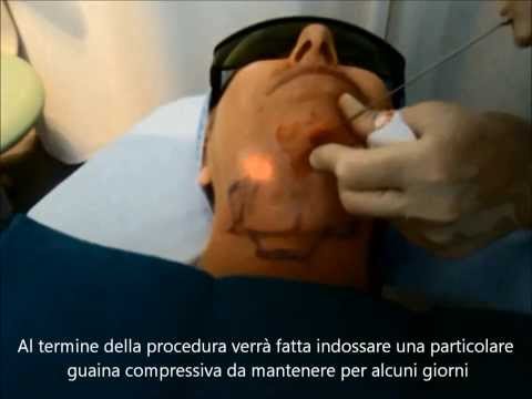 Eliminazione laser di lentiggini in Rostov Decolorazione della persona Almaty