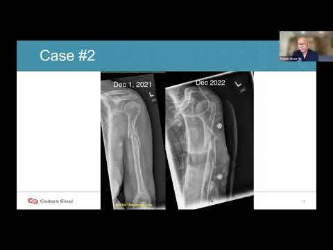 The IlluminOss Solution: How to treat bone compromised nonunions using IlluminOss