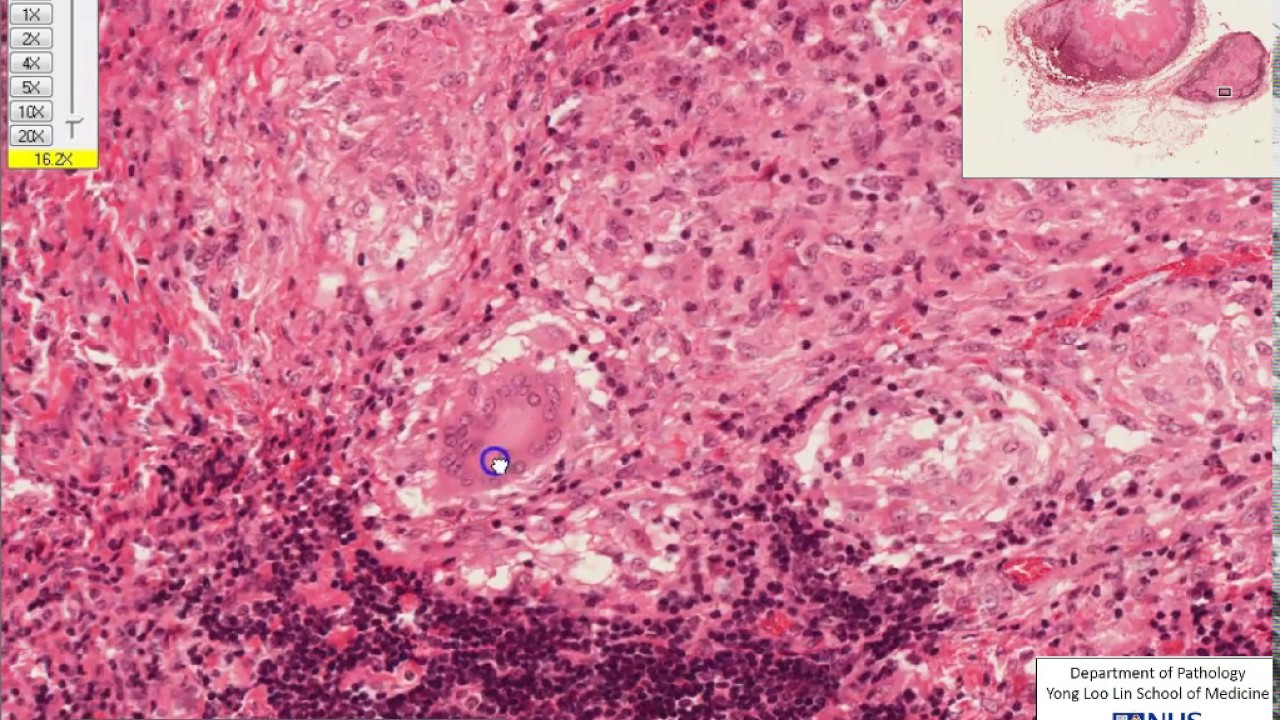 Lymph node: Granulomatous lymphadenitis microscopy