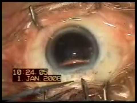 Vid-IC-APAO-simple secondary Intraocular lens Implantation in an Aphakic Patient-1
