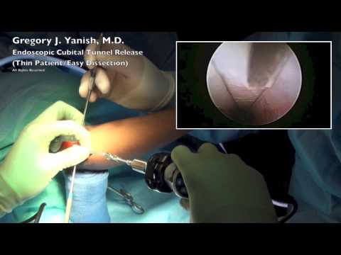 Endoscopic Cubital Tunnel Release (Thin Patient/Easy Dissection)