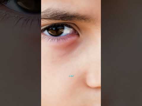 CONJUNTIVITIS detectala tiempo ⏳