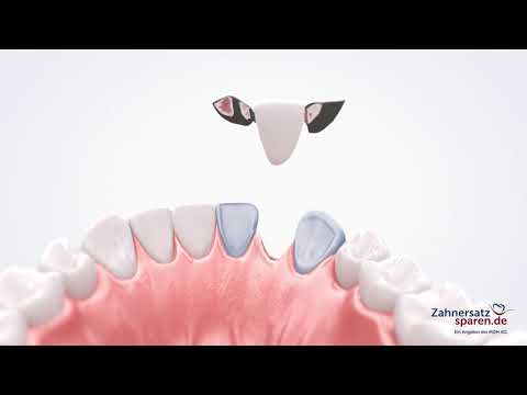 Behandlungsablauf: Marylandbrücke (Klebebrücke / Adhäsivbrücke)