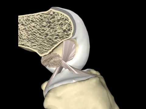 Deformáló osteoarthritis az interphalangealis ízületek