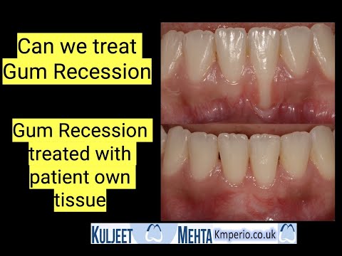 Leczenie recesji dziąseł po leczeniu ortodontycznym