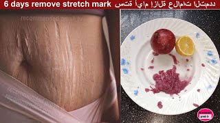 Fastest way to remove stretch marks with Lemon and onion / natural remedies for stretch marks