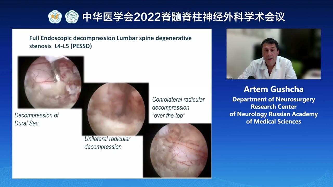 Full endoscopic procedure for Degenerative Spine Stenosis