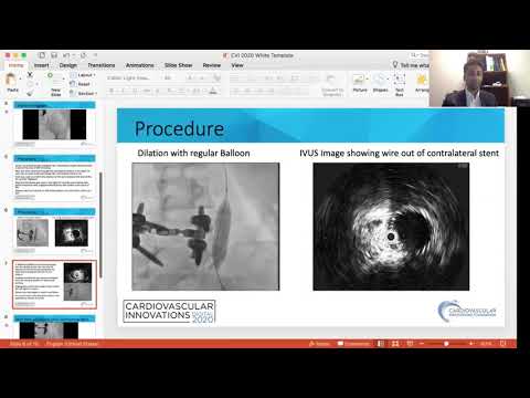 Radaideh_Manejo da veia ilíaca comum contralateral trombosada_Periférica