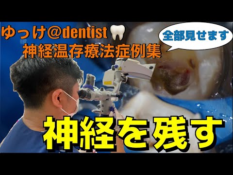 生命歯学科 【治療症例集】神経を絶対取るな！マイクロスコープを用いた歯の神経を救う神経温存療法（VPT治療）全部見せます！ノーカットでお送りします！