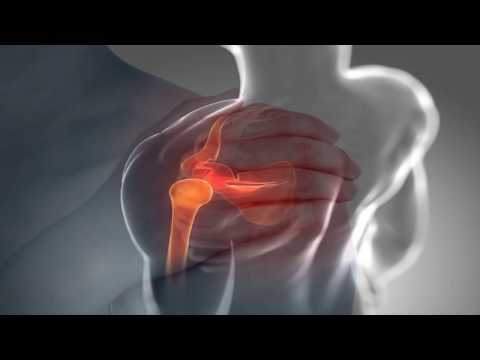 Dolor persistente en la parte posterior de la hoja Técnica de la punción de la rodilla conjunta de vídeo