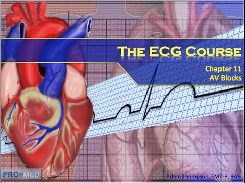 The ECG Course - AV Blocks