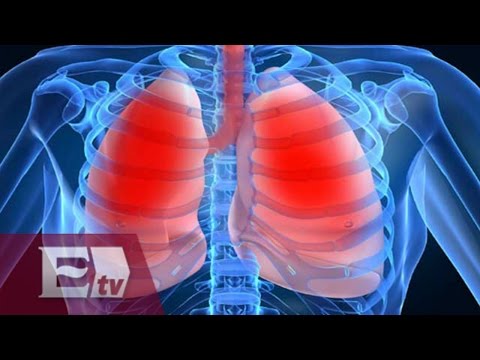 ¿Qué es la hipertensión pulmonar? / Salud