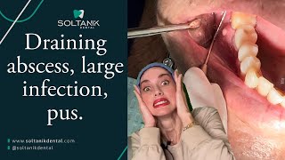 Large tooth abscess that bursts. #infection #dentist #viralvideo