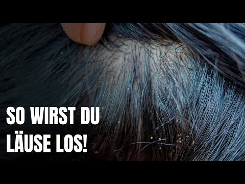So wirst du Läuse auf natürliche Weise los!