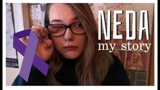 Fat Girls Can't Have Eating Disorders