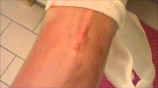 Spider moving under skin