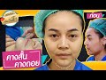 ร้อยไหม หน้าเรียว
