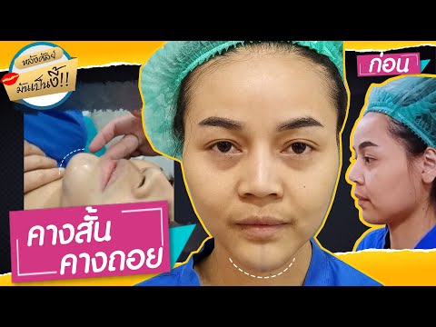 ร้อยไหม หน้าเรียว