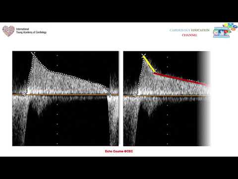 image-What is mitral valve pressure half time?