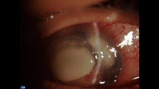 Corneal infections: Practical approach webinar