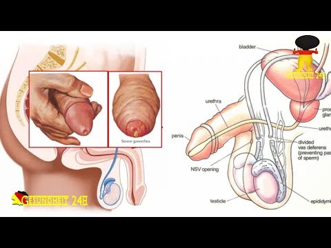 Ziehender Schmerz in der Prostata Die Behandlung der akuten Prostatitis Sex