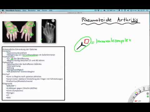 A rheumatoid arthritises betegek rehabilitációja