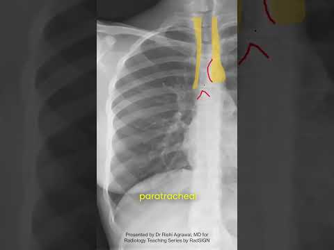 Trachea, carina, and the paratracheal stripe on Chest Xray | RadSIGN #cxrinterpretation